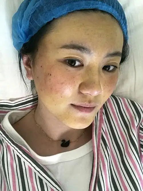 术后1天 做完线雕第1天,脸上现在比较红肿还有淤青,虽然是刚做完但是