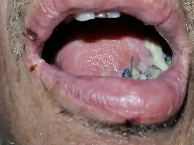 【南华医院乳甲外科】mdt多学科合作,滚蛋吧,舌癌君!