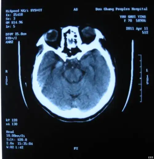 原创颅脑ct片帮忙看看