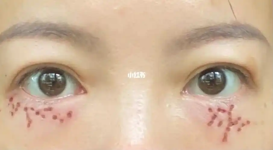 汗管瘤激光三天变化