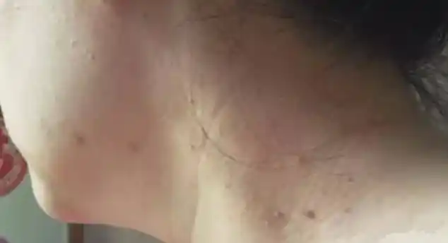 脖子上的丝状疣传染的越来越多别害怕丝瓜叶盐一抹就掉了