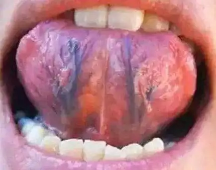 舌下青筋发出这3种信号别大意了