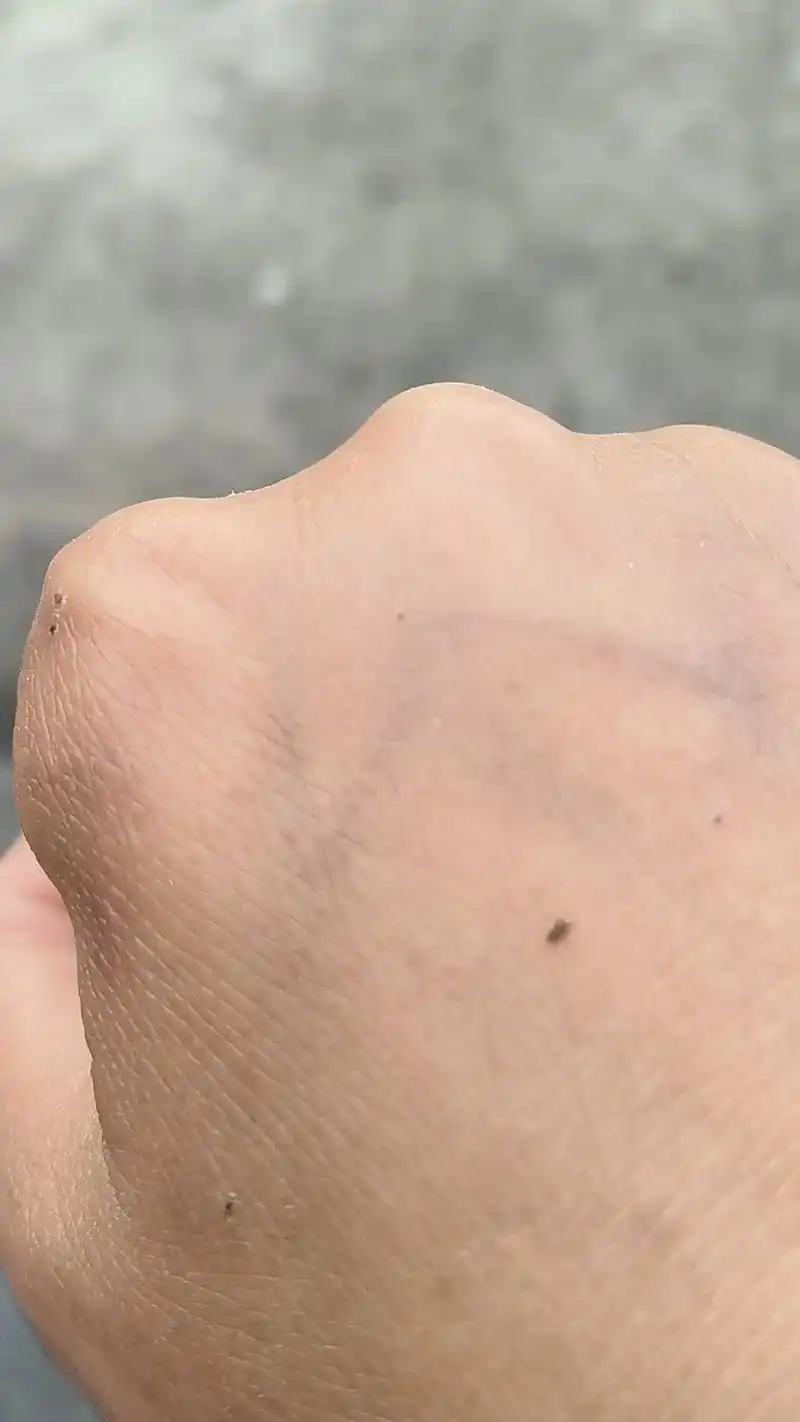 该死的蚊子 ,这种小黑点蚊子叮的好痒都起包了