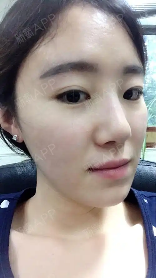 今天是打水光针后第7天了,感觉恢复的特别好,皮肤也显白了,每天不用