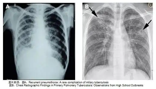 分布平均,密度相似,巨细一致的粟粒状结节(原发性肺结核,哑铃状的原发