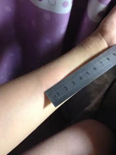 肺结核皮试后肿很大呀,有三厘米很痒!求解释!是患病了吗!