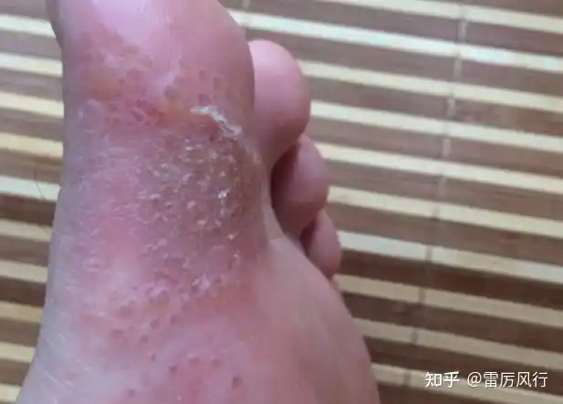 水泡型脚气的水泡需要戳破吗?还是用药后会自动消掉呢?
