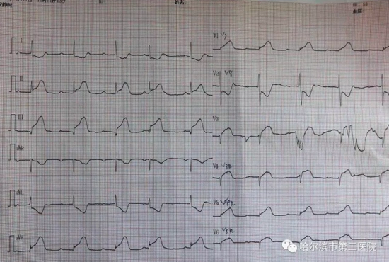 或许这是急性心梗在"报警"