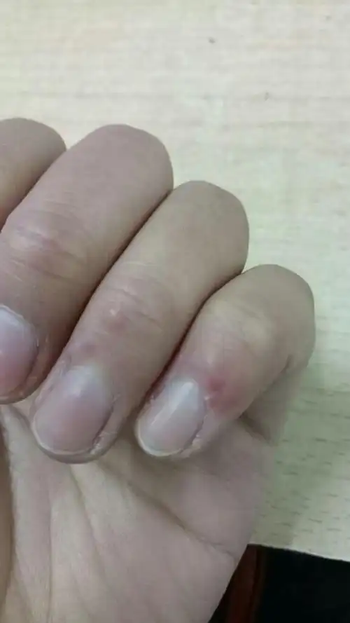 手指上起痘痘,红肿,会痒,一个星期了,触碰还有一点疼