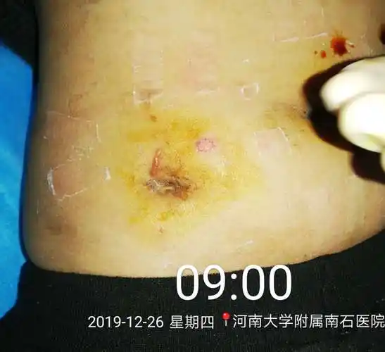 小小的阑尾炎术后伤口为啥不愈合?