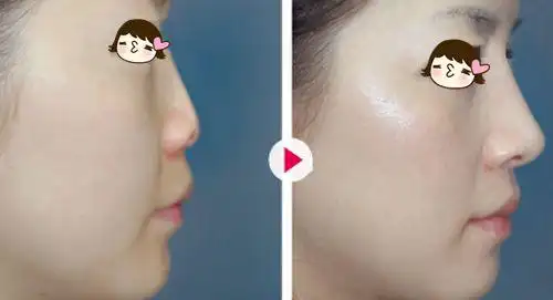 注射治疗整容鼻子维持多久