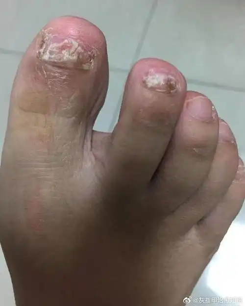 灰指甲##灰指甲怎么治