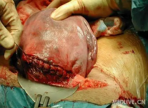 一组高清晰的剖腹产手术全过程照片