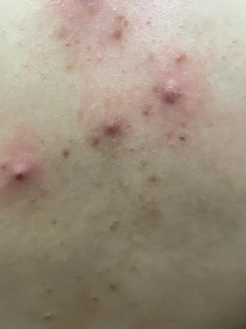 后背马拉色菌毛囊炎 面部未检查 - 皮肤及性传播疾病讨论版 - 爱爱医