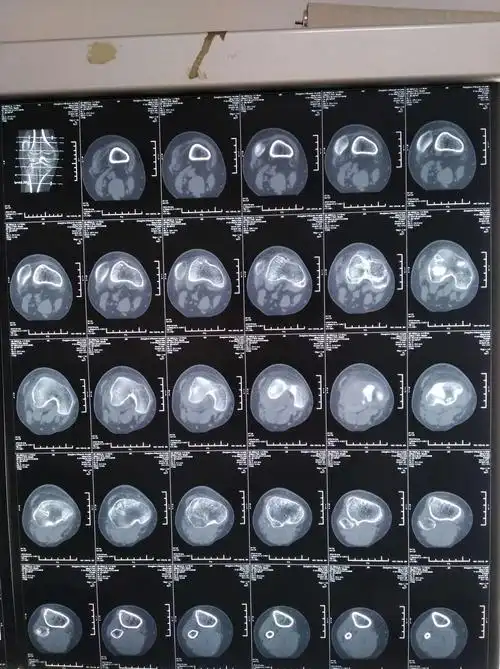 右髌骨脱位一例