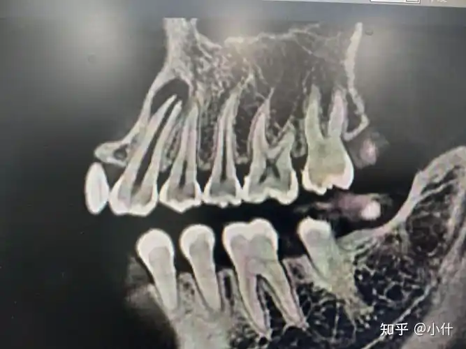 记录我的第一次手术全过程根尖囊肿