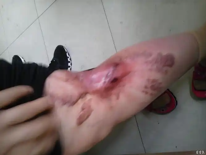 严重的疤痕体质!