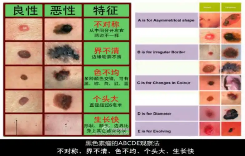 普通痣一般小于5毫米,而恶性黑色素瘤直径超过6毫米.