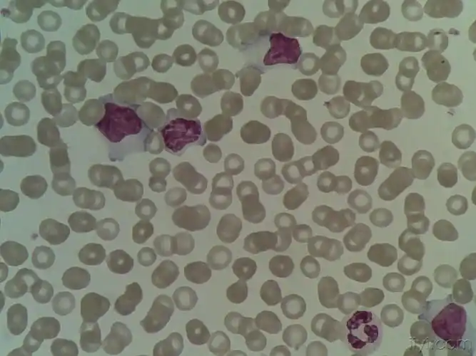 血片中的异型淋巴细胞 (一)