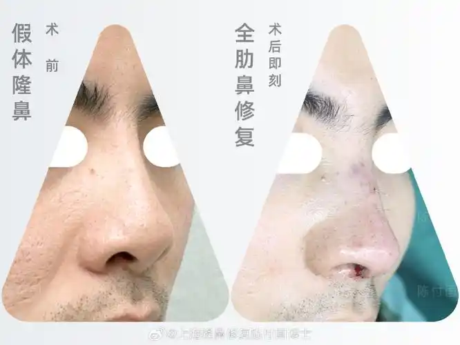 短高通天鼻变"陈飞宇"鼻:    小帅哥原生鼻就是超高山根,又在鼻背植入