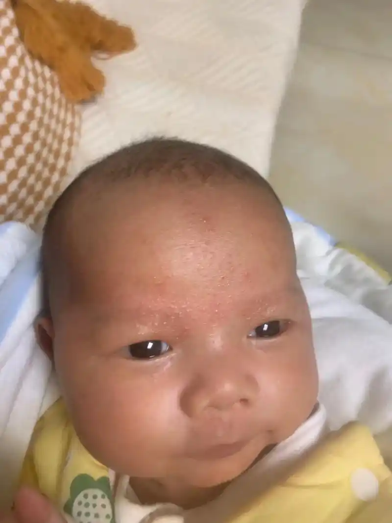 过敏宝宝是什么样子的,我来告诉你.1.反复的湿疹,又干又痒, - 抖音