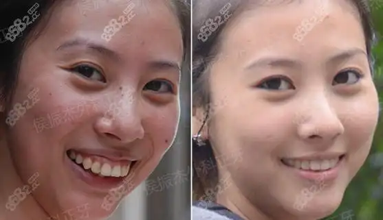 三张骨性龅牙正颌手术矫正效果图,花费11万