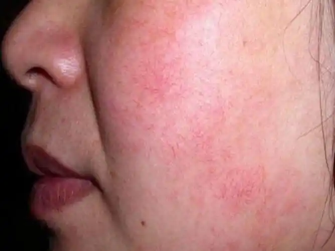 去除脸上红血丝的有效方法