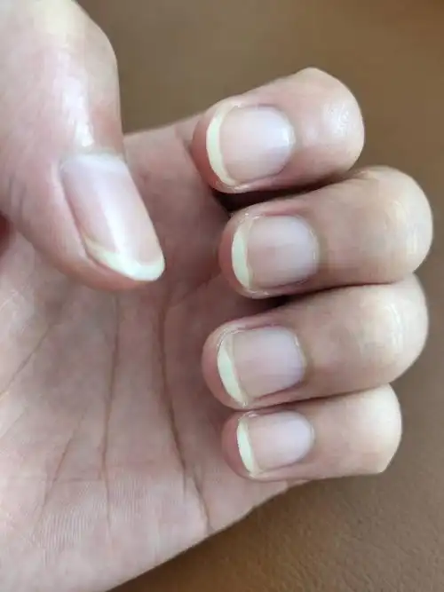 手指甲为白色是不是缺少维生素已经有好几年了