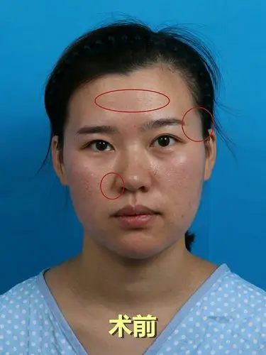 坐标:常州 项目:自体脂肪面部填充 我照片看起来挺显老的,其实才25岁.