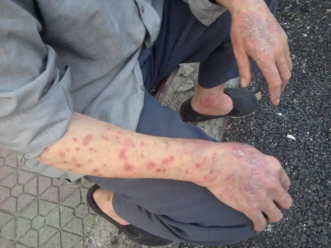 上海什么地防治银屑病啊?吃中药三天后奇痒没办法我就