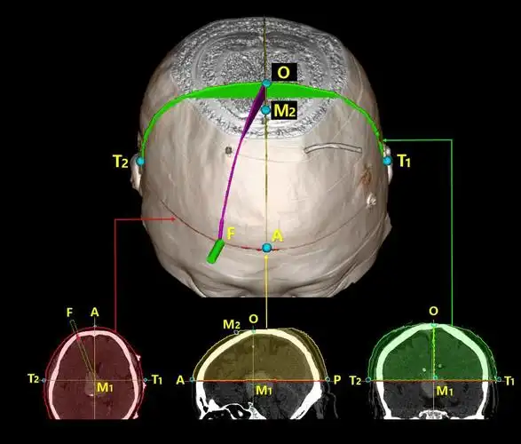 下图中从左至右依次为横断位(轴位),矢状位,冠状位.