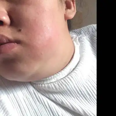 请问大家我怀孕35周了可是最近几天因为牙疼闹的我右脸肿起来啦请问我