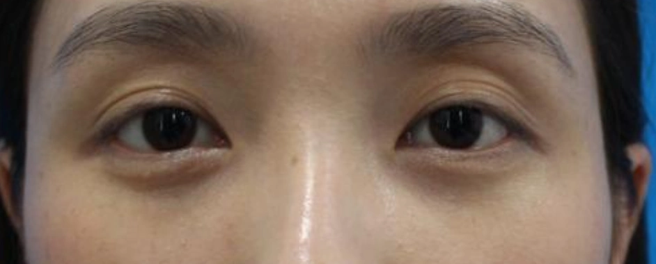 师丽丽眼修复丨双眼皮多层褶/多层眼皮可以进行修复吗?