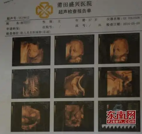 陈淑霞 实习记者 陈朝杰)8月7日本网报道了《胎儿彩超检查正常产后现
