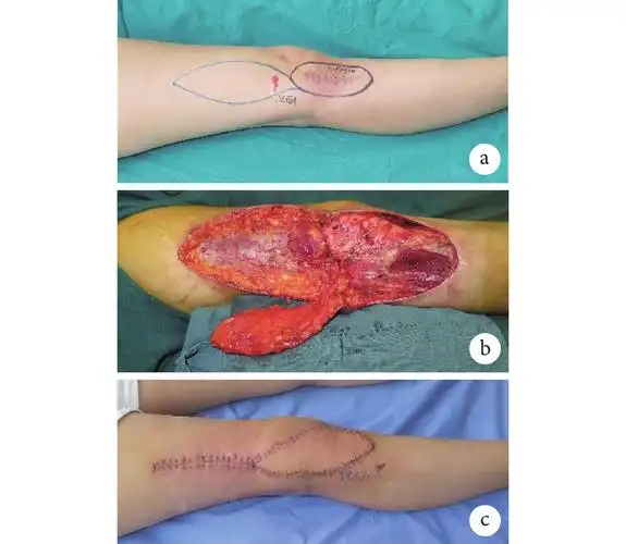 膝上外侧动脉穿支螺旋桨皮瓣修复膝关节周围软组织缺损