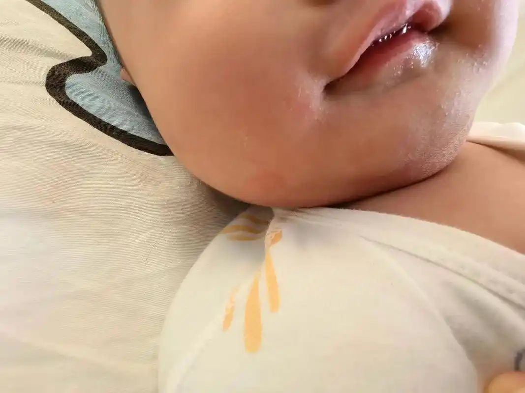 6个月宝宝口水疹.6个月宝宝下巴脖子#口水疹 反反复复,每天 - 抖音