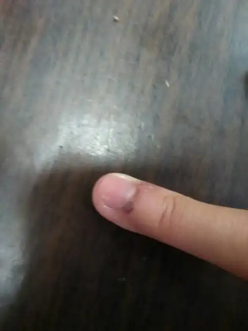 手被门挤到了,起了一个小血包,可以用针挑掉吗?或者是等它自己消失?