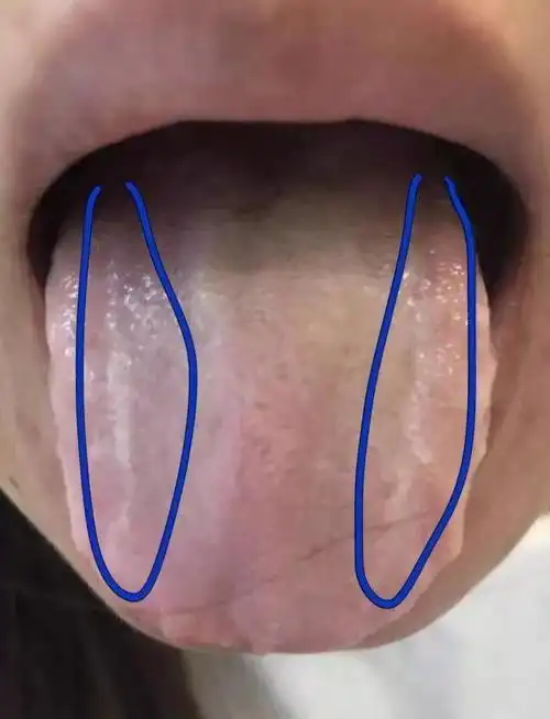 舌头四周有齿痕二:齿痕舌代表你身体出现了不同的问题!