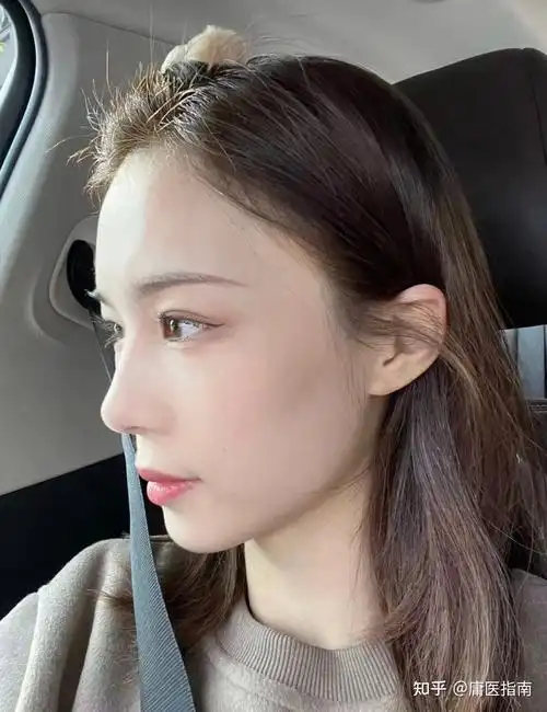 鼻整形直鼻or翘鼻or直鼻微翘3个核心要点