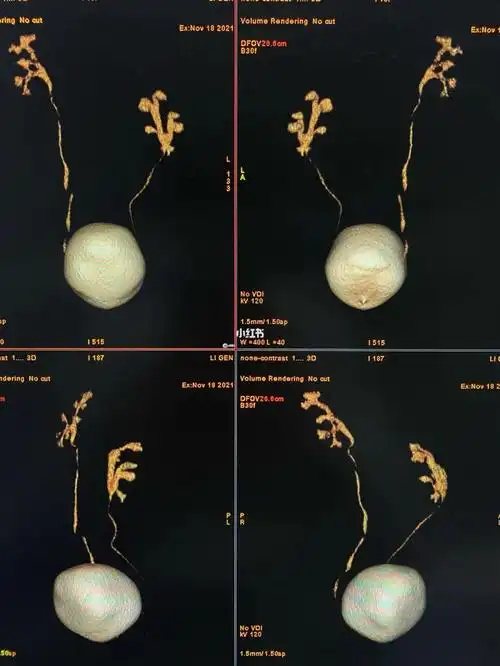 左肾双肾盂畸形_医学生_医疗健康_医疗健康其他