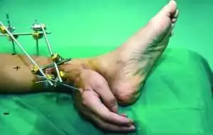 断手寄养脚踝1个月后回植成功(组图)