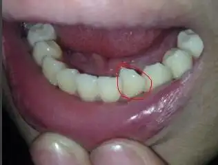 得了牙隐裂该怎么办呢?