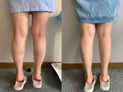 新氧体验官 瘦腿针真的是针针有效 第一次两只腿