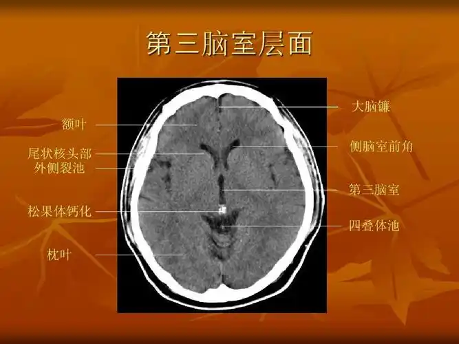 脑 额叶 尾状核头部 外侧裂池 松果体钙化 层 大脑镰 侧脑室前角 第三
