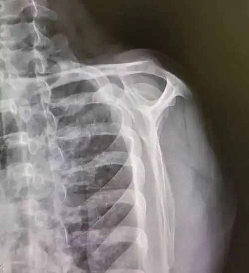 正常距离为10~15mm,狭窄为小于10mm,严重肩袖损伤为小于5mm.