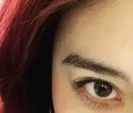 求助,眉压眼怎么办,(反馈)