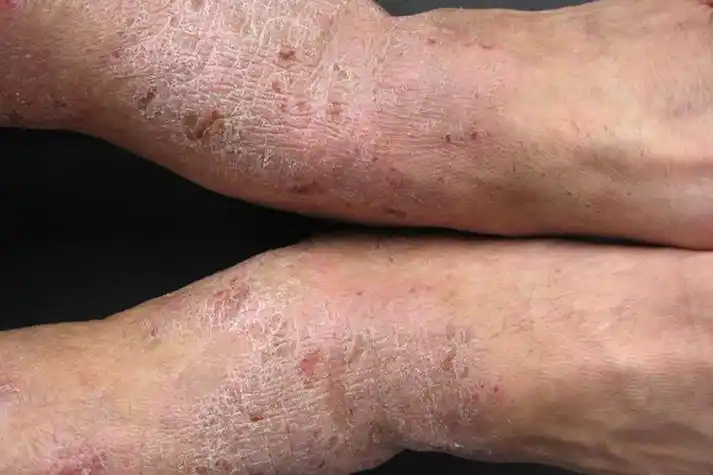 足部慢性湿疹图