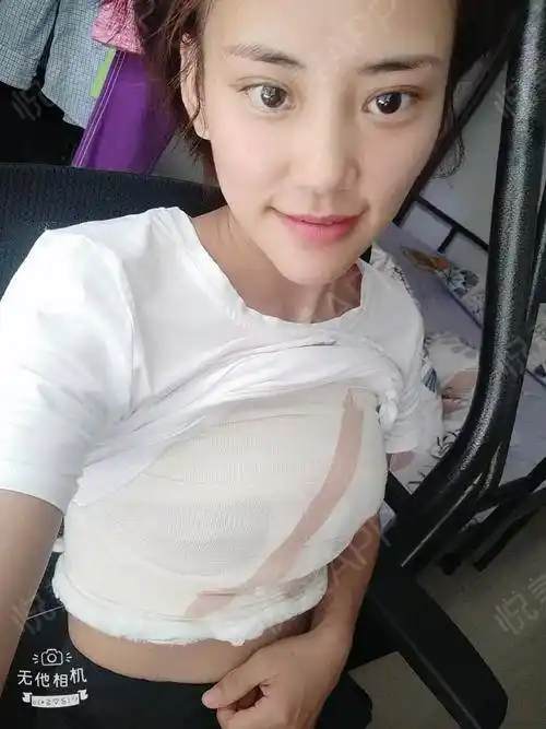 假体隆胸手术当天_隆胸手术当天_胸部整形手术当天_蛊惑人心※分享