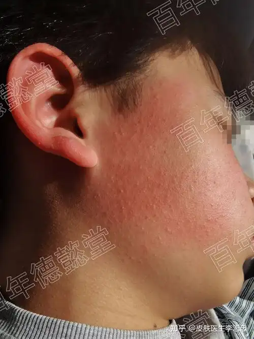 什么是面颈毛囊红斑黑变病?该怎么治疗?