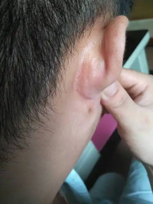 有谁能帮我看看耳朵后面长这个是什么东西